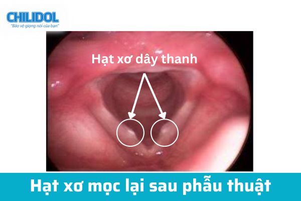 Hạt xơ mọc lại sau phẫu thuật