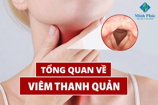 Những nhóm người nào có nguy cơ cao mắc viêm thanh quản và cần đặc biệt chú ý đến bệnh này?
